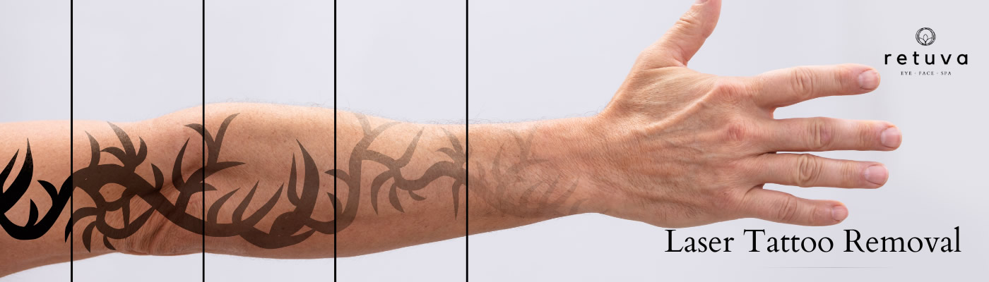 Learn 95 about does tattoo removal leave a scar latest  indaotaonec