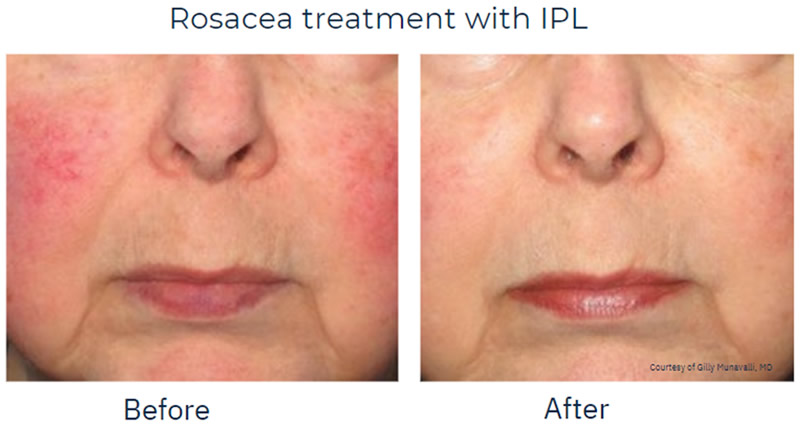 Rosacea before and after