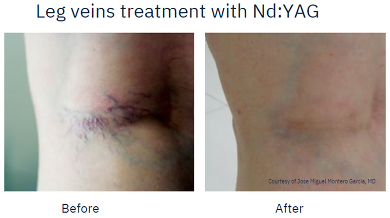 Spider Vein Removal before and after