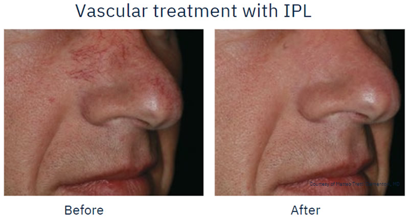 Vascular Lesion Removal before and after